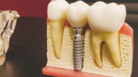 Implants & Dentures