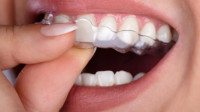 Clear Aligners