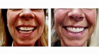 Porcelain Dental Veneers in Morton Grove, IL